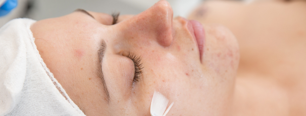 Picking The Right Peel For Your Client – Dermaesthetics Beverly Hills