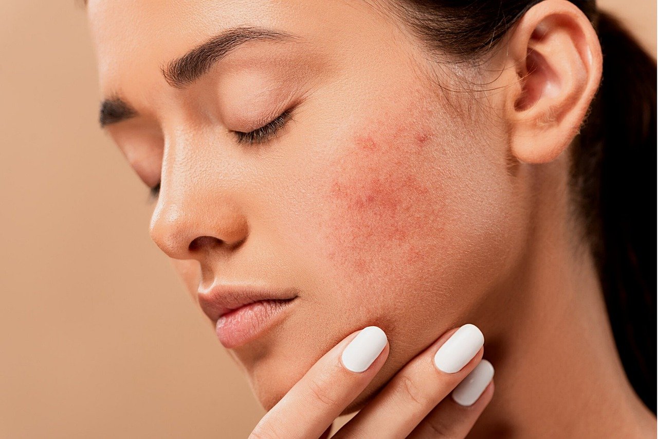 Esthetician Recommended Products To Help Treat Acne