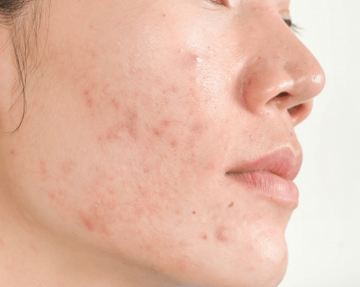 Clear and Nourish Acne Prone Skin