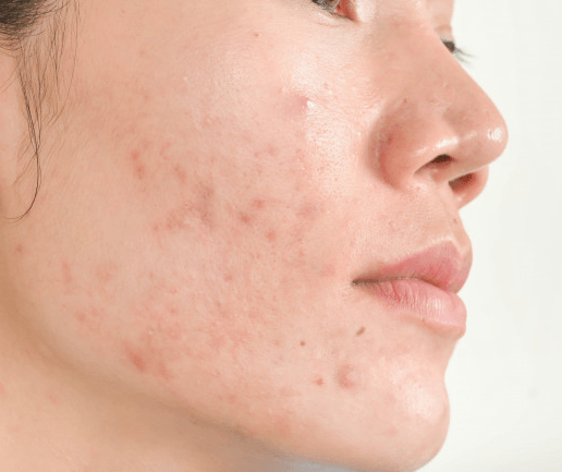 Clear and Nourish Acne Prone Skin